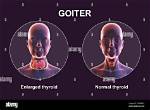 Why Does Goitre Occur?
