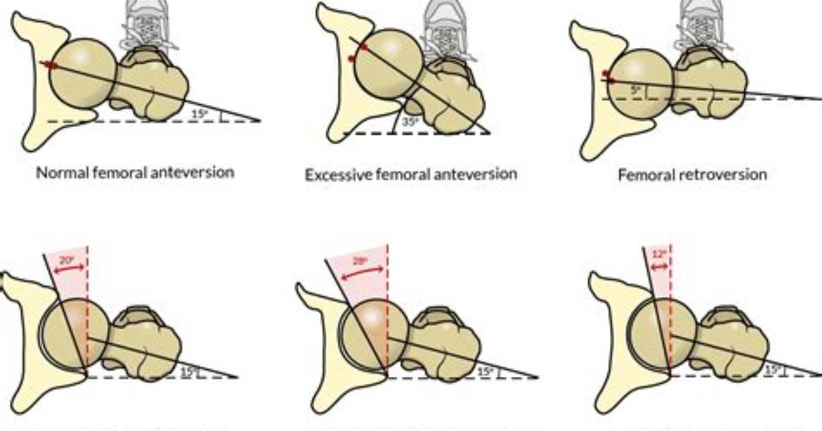 Why Does Hip Retroversion Occur?