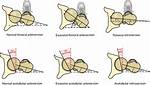 Why Does Hip Retroversion Occur?