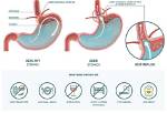 Why Does Hyperacidity Happens?