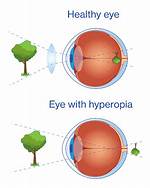 Why Does Hyperopia Happen?