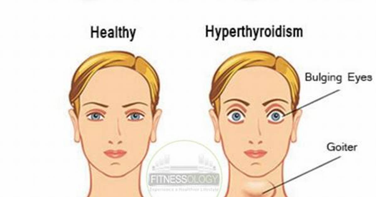 Why Does Hyperthyroidism Cause Weight Loss?