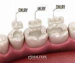Why Does Inlay Mean?