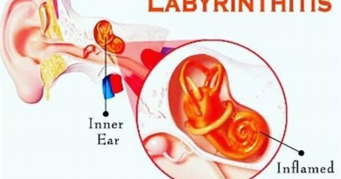 Why Does Labyrinthitis Reoccur?