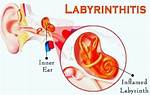 Why Does Labyrinthitis Reoccur?