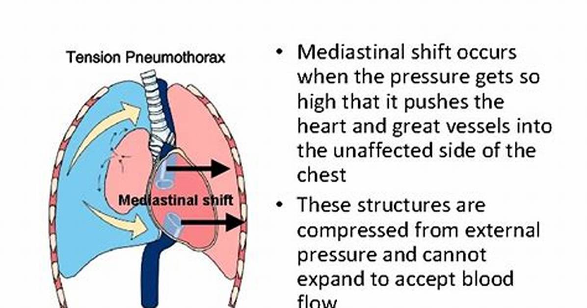 Why Does Mediastinal Shift Occurs?