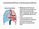 Why Does Mediastinal Shift Occurs?