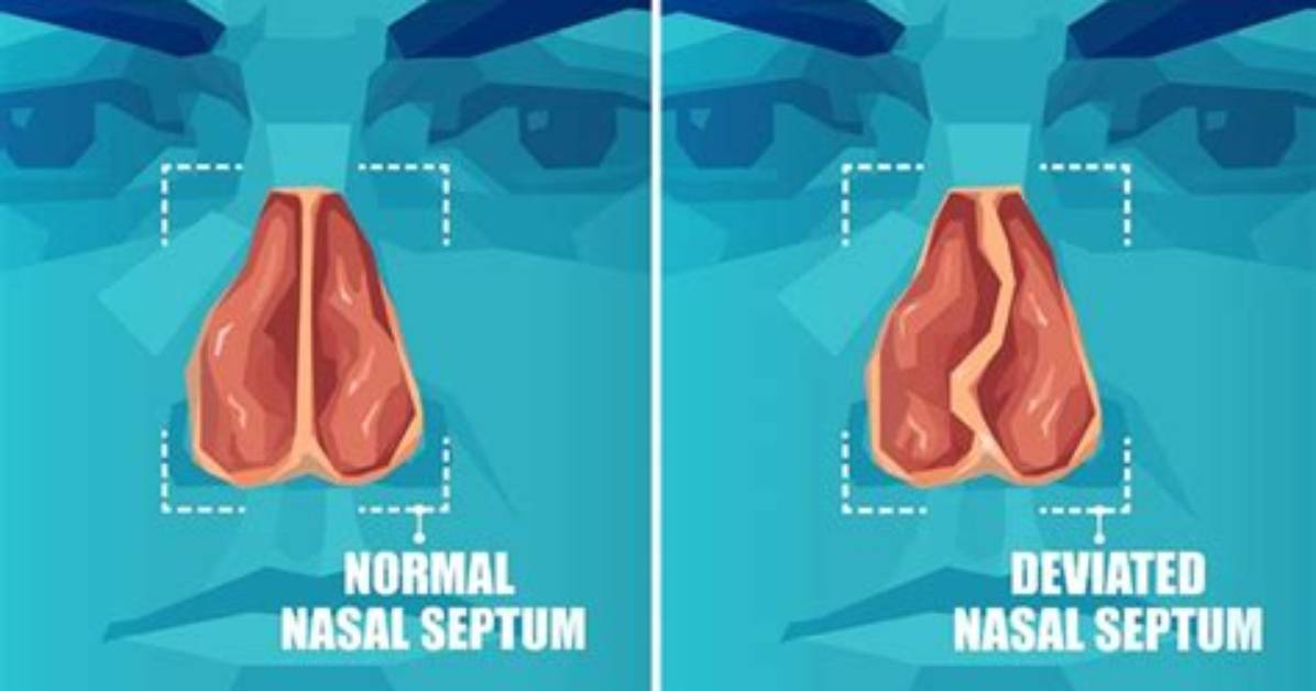Why Does My Septum Keep Deviating?