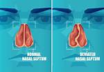 Why Does My Septum Keep Deviating?