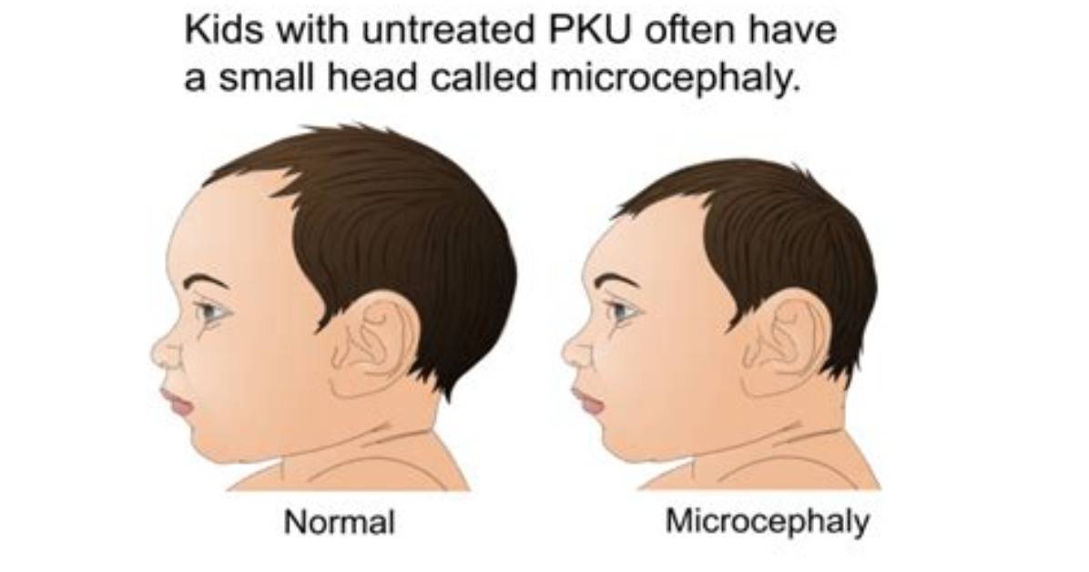 Why Does Pku Cause Microcephaly?