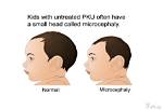 Why Does Pku Cause Microcephaly?