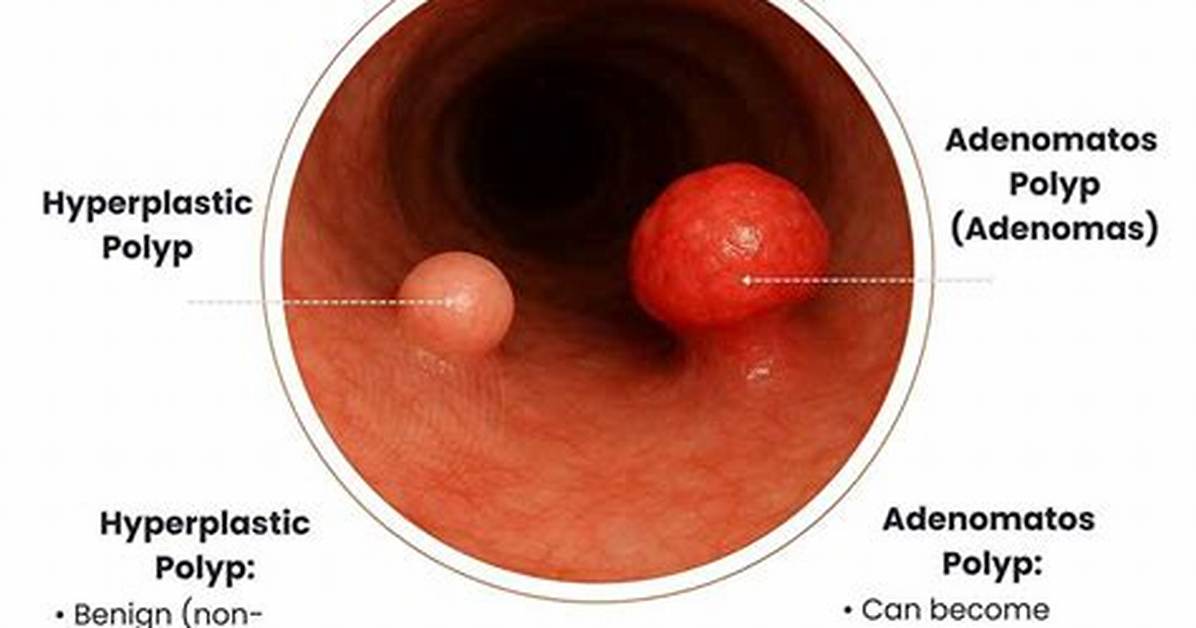 Why Does Polyps Occur?