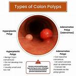 Why Does Polyps Occur?