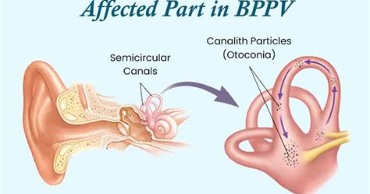 Why Does Positional Vertigo Occur?