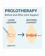 Why Does Prolotherapy Work?
