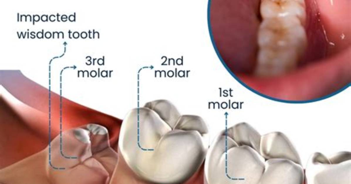 Why Does Pulling a Tooth Stop the Pain?