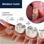 Why Does Pulling a Tooth Stop the Pain?