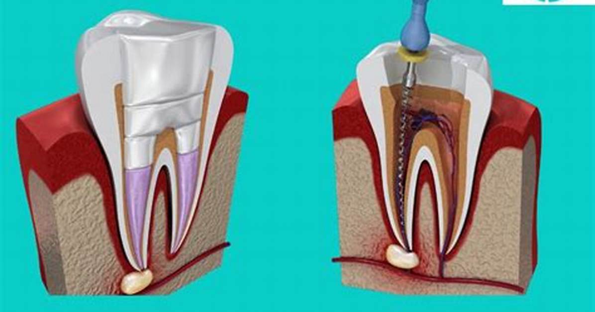 Why Does Root Canaled Tooth Hurt?