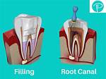 Why Does Root Canaled Tooth Hurt?