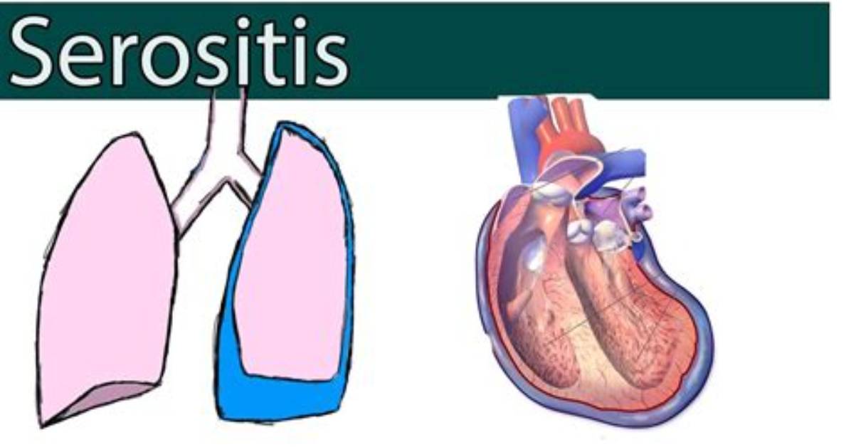 Why Does Serositis Occur?