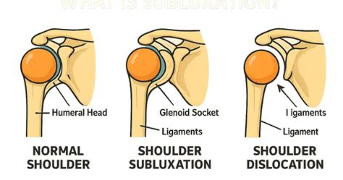 Why Does Subluxation Occur?