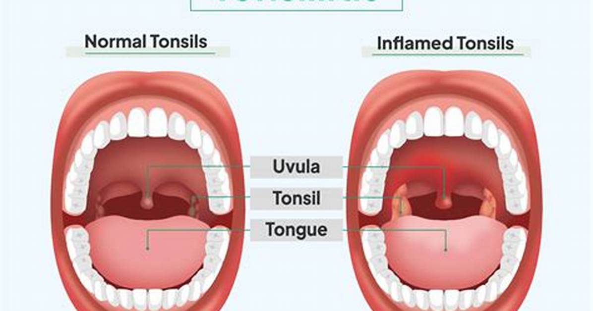 Why Does Tonsillitis Happen?