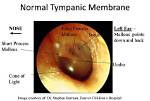 Why Does Tympanic Mean?