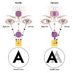Why Double Vision Occurs?