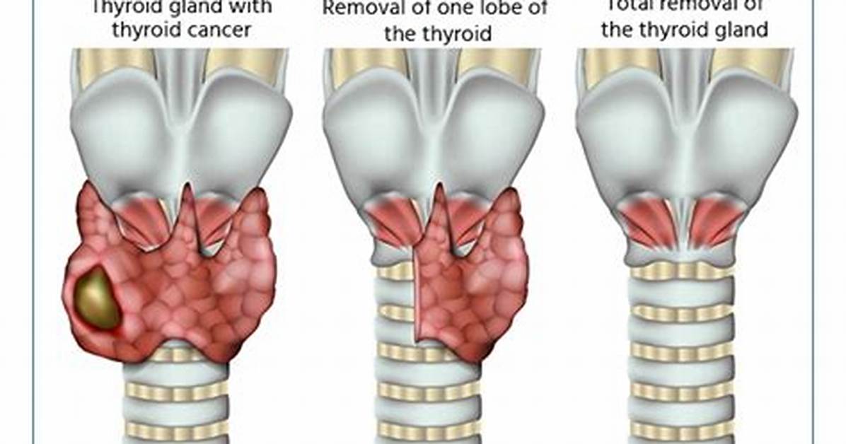 Why Euthyroid Before Thyroidectomy?