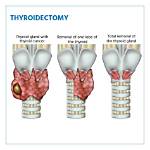 Why Euthyroid Before Thyroidectomy?