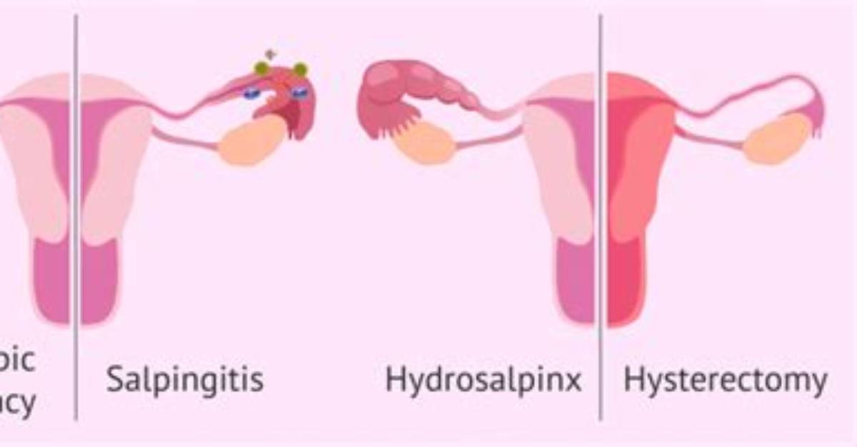 Why Get a Salpingectomy?