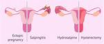 Why Get a Salpingectomy?