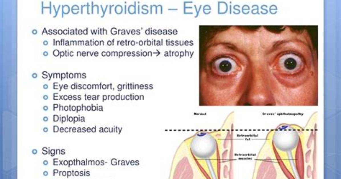 Why Hyperthyroidism Cause Exophthalmos?