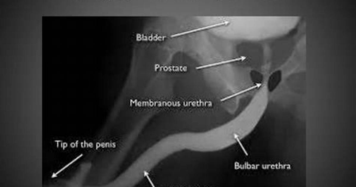 Why Is a Urethrogram Done?