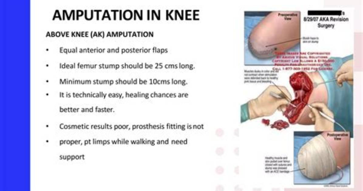 Why Is Amputation Necessary?