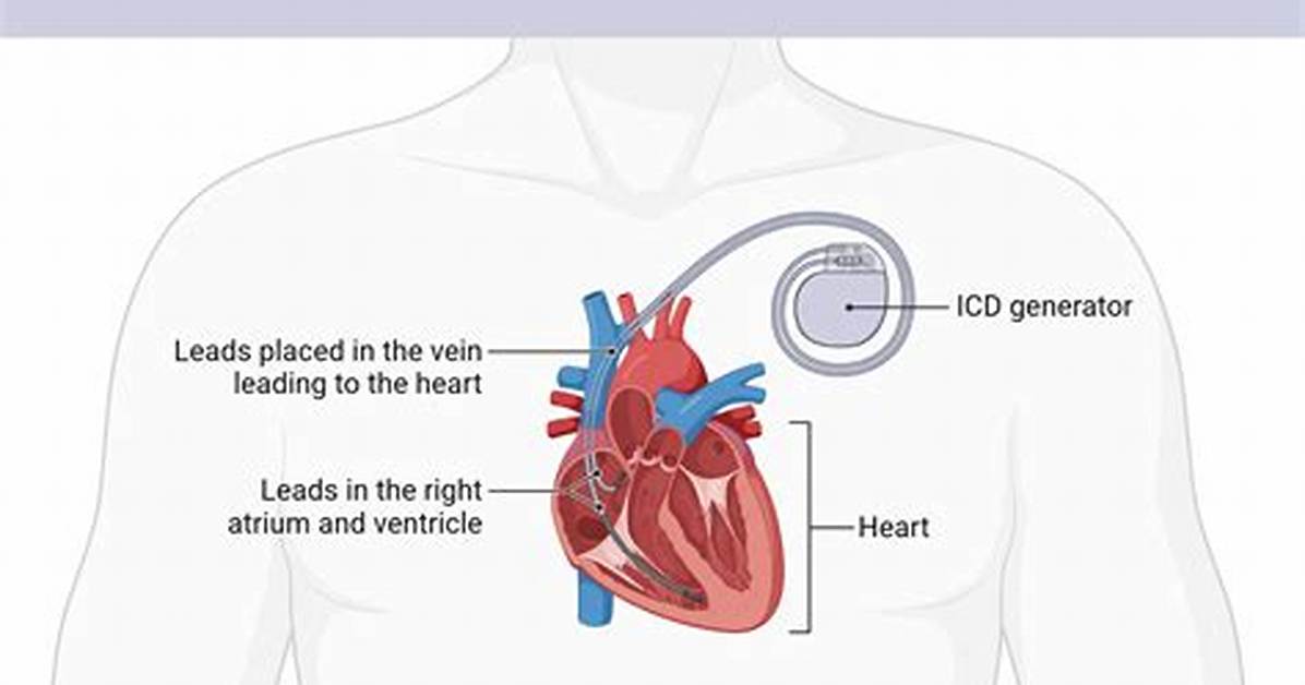 Why Is an Icd Implanted?