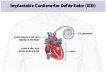 Why Is an Icd Implanted?