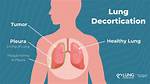 Why Is Decortication Performed?