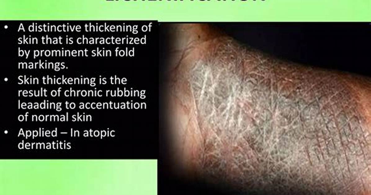 Why Is It Called Lichenification?