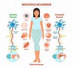Why Is It Called Multiple Sclerosis