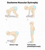 Why Is It Called Pseudohypertrophy?