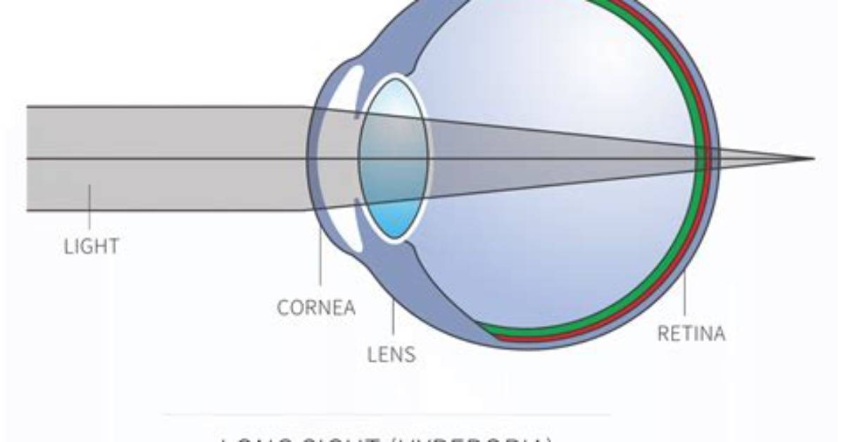 Why Is Long-Sightedness a Problem?