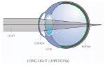 Why Is Long-Sightedness a Problem?