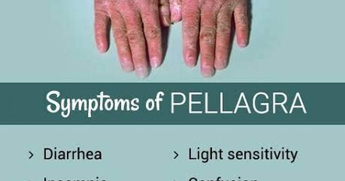 Why Maize Causes Pellagra?