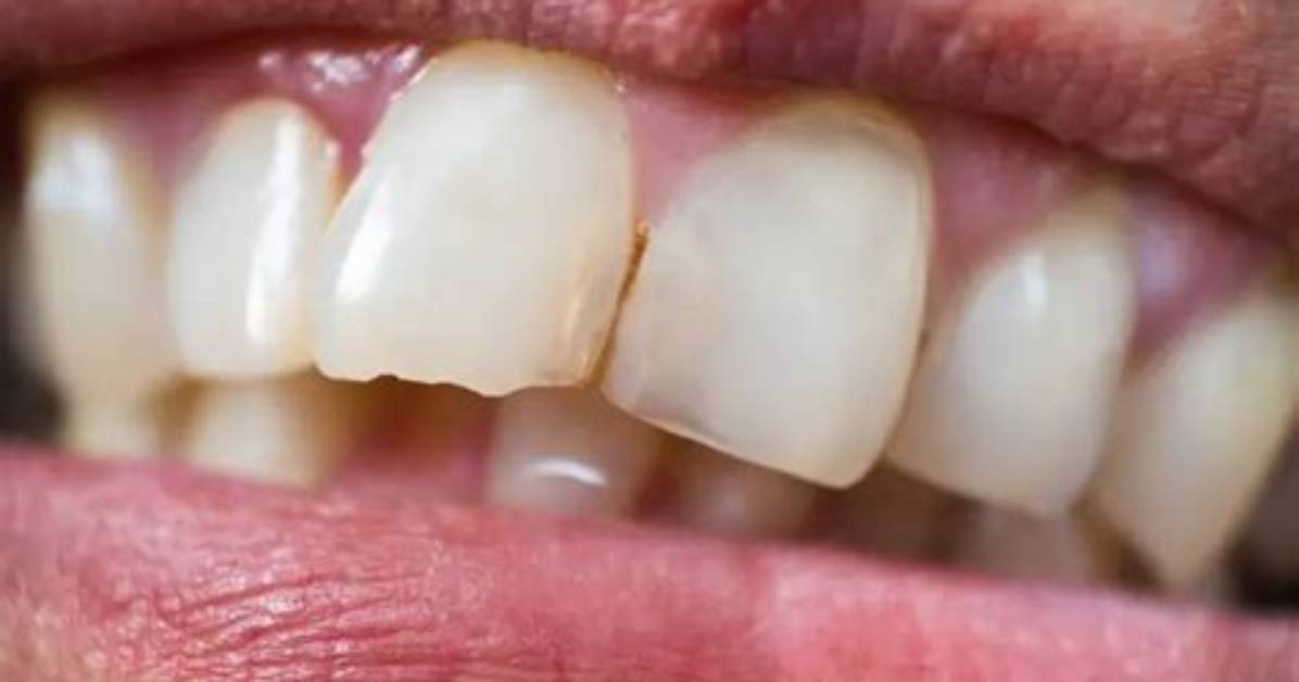 Why My Teeth Edging?