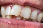 Why My Teeth Edging?