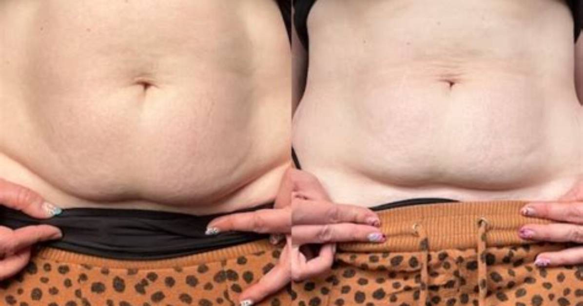 Why Overhang After C Section?