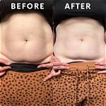 Why Overhang After C Section?