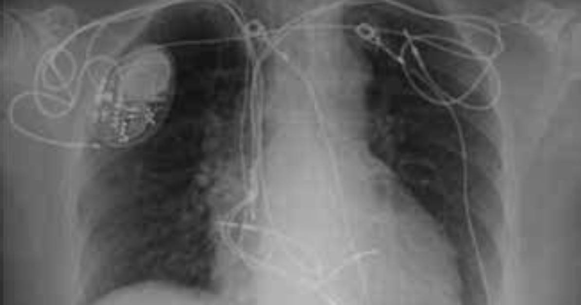 Why Pacemaker on the Right Side?