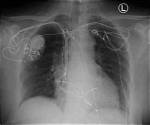 Why Pacemaker on the Right Side?